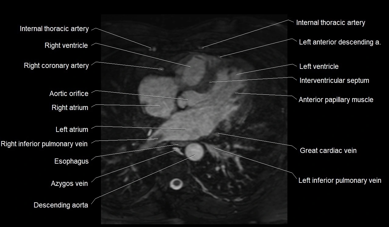 MRI heart coronary arteries and coronary veins anatomy axial image 25.webp